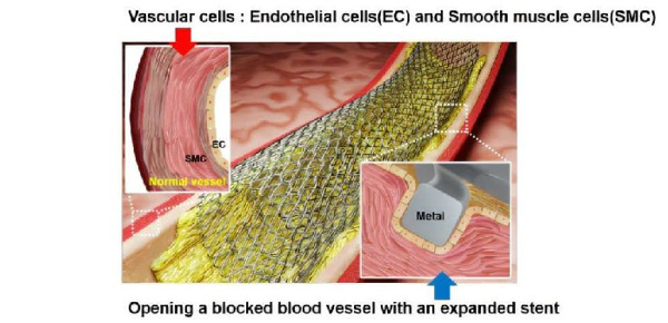 Công nghệ laser mới nâng cao hiệu quả stent trong điều trị mạch máu